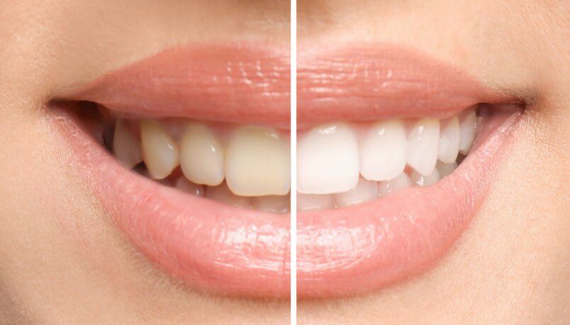 before and after procedure of teeth whitening in Sandpoint, ID