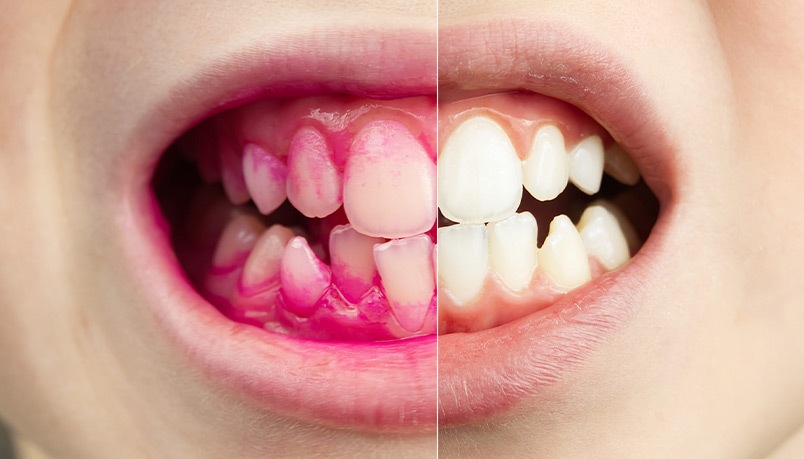 A young woman in distress due to a toothache, highlighting the need for emergency dentistry services in Sandpoint.